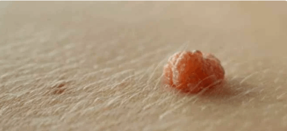 Papilloma