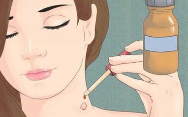 How to get rid of the popular remedies of papillomas