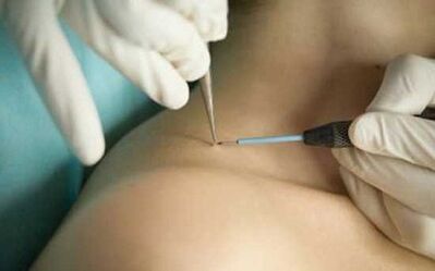Papillomas removal methods