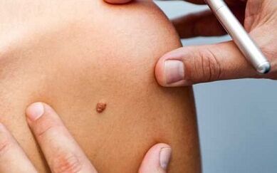 Papillomas treatment methods