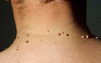Reasons for appearing papillomas