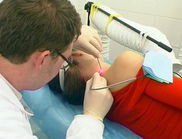 Removing papilloma