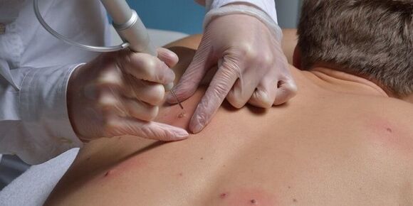 Removing papillomas