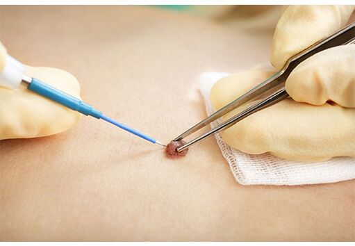 Removing papillomas