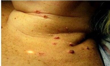 Pictures of many papillomas in women