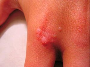 How to get rid of small papillomas