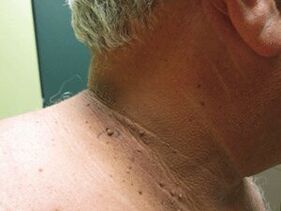 Reasons for the appearance of plural papillomas in the body