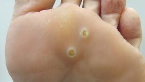 What does a plantar wart look like