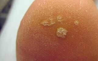 Why do plantar warts appear