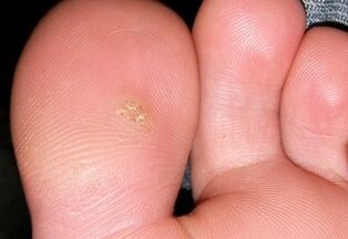 how to get rid of plantar warts