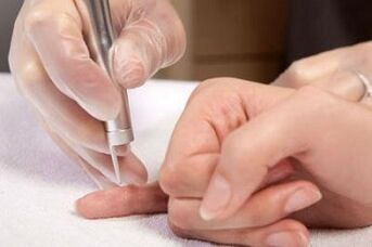 How to get rid of papillomas on the body