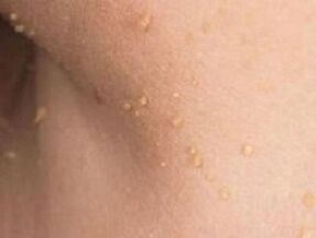 the reasons for the appearance of papillomas on the body