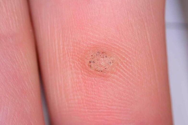 what are warts