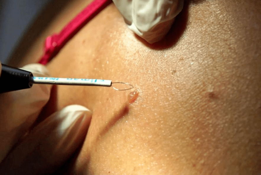 professional method for removing papillomas