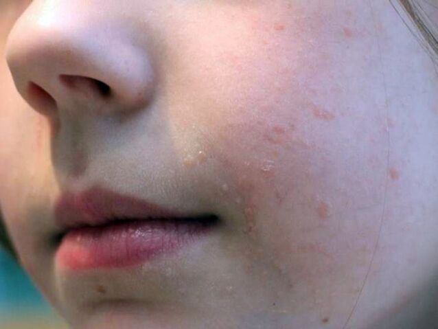 Flat warts on the face appear more often during adolescence