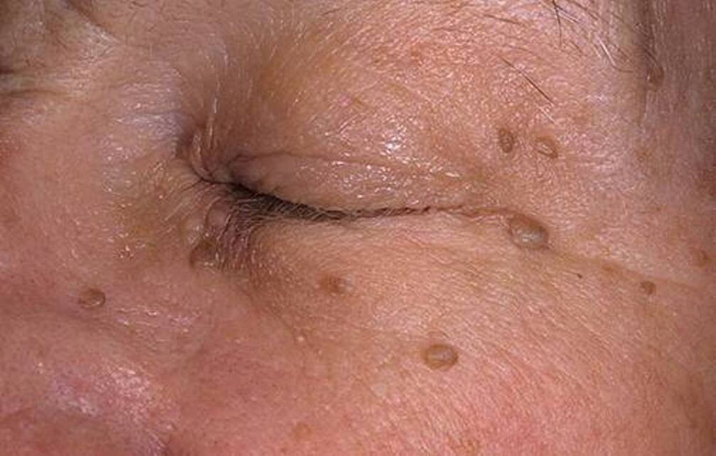 Papilloma on the skin of the face